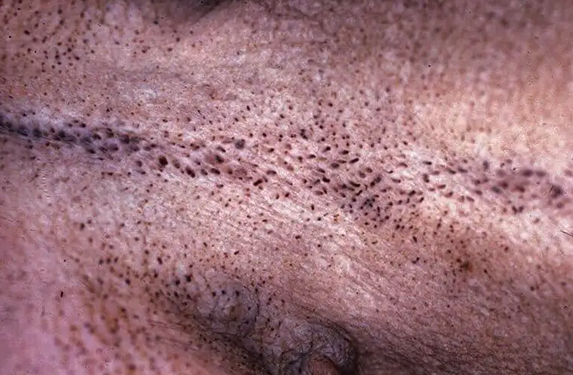 Blackheads on dog