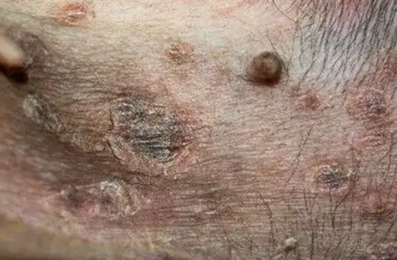 dog Epidermal colarettes healing